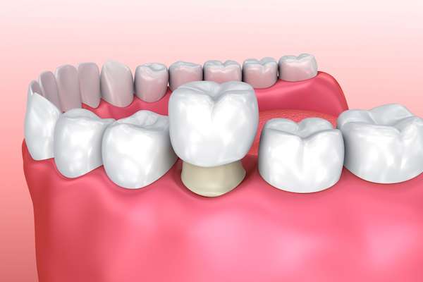 Permanent Dental Crowns Vs Temporary: Is There A Difference